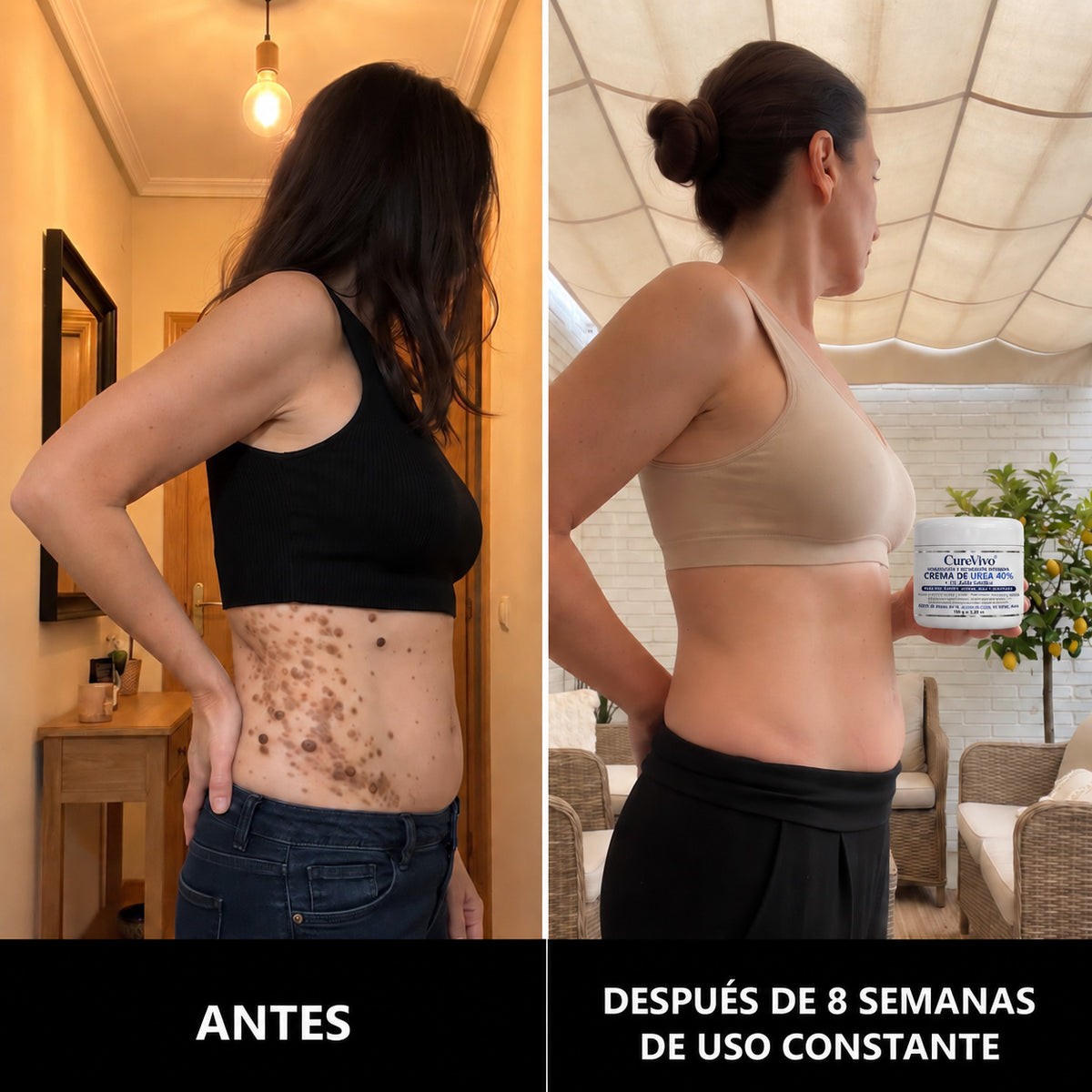 🇪🇸👨⚕️✅𝗖𝘂𝗿𝗲𝗩𝗶𝘃𝗼® SK Renewal 40 — Crema Queratolítica Avanzada para Queratosis Seborreicas Rugosas y en Relieve🤗2️⃣