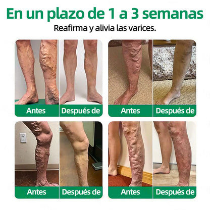 🦵🦵🦵Parche de Microagujas Healrize® VeinTarget —— Alivio Instantáneo, Resultados a Largo Plazo