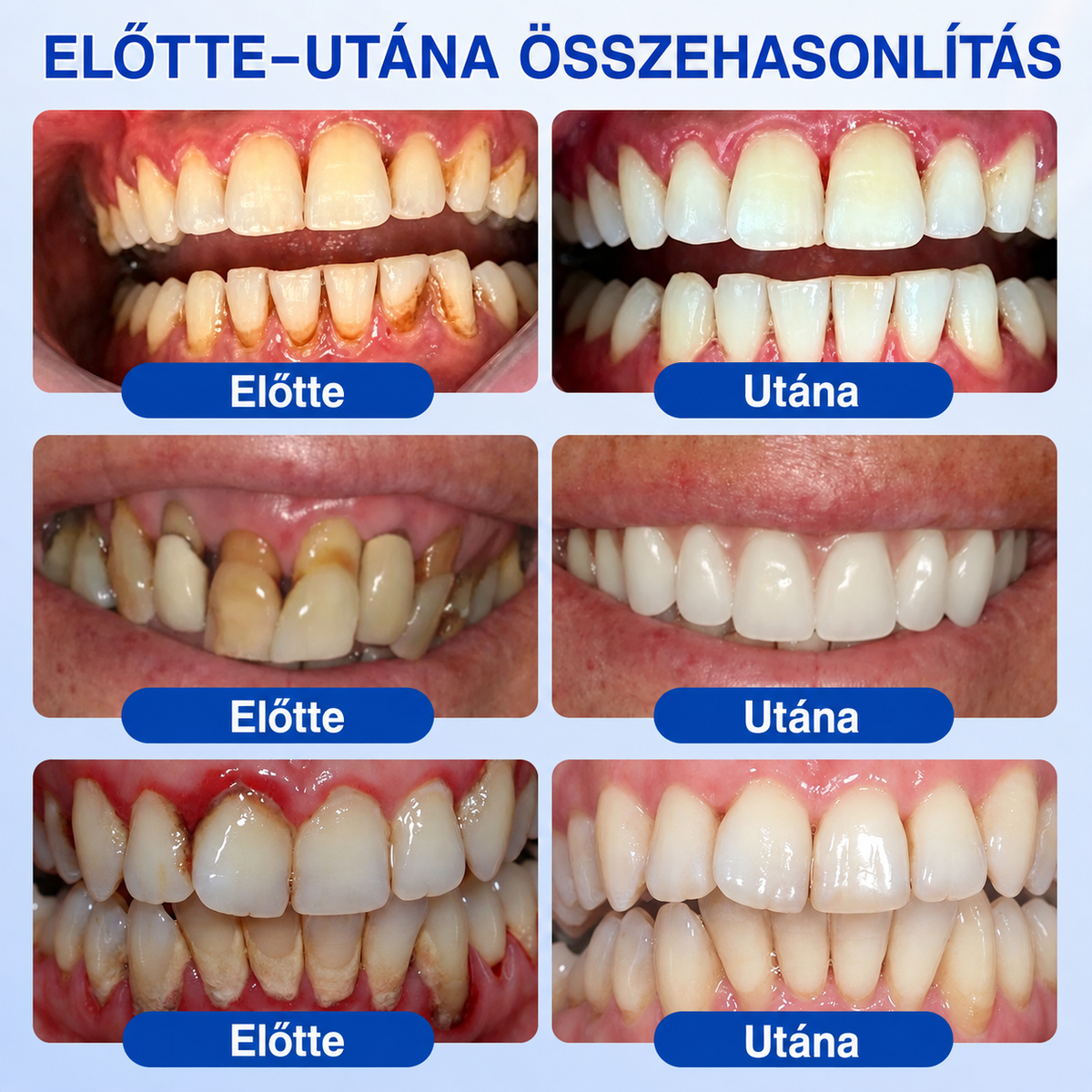🇭🇺👨‍⚕️✅🦷 HEATWOLF® GumRevive – Parodontális helyreállító gél🦷✨3️⃣6️⃣