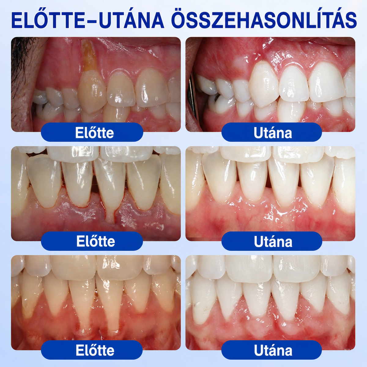 🇭🇺👨‍⚕️✅🦷 HEATWOLF® GumRevive – Parodontális helyreállító gél🦷✨3️⃣6️⃣