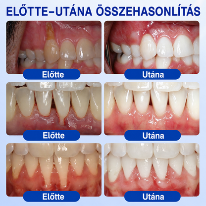 🇭🇺👨‍⚕️✅🦷 HEATWOLF® GumRevive – Parodontális helyreállító gél🦷✨3️⃣6️⃣