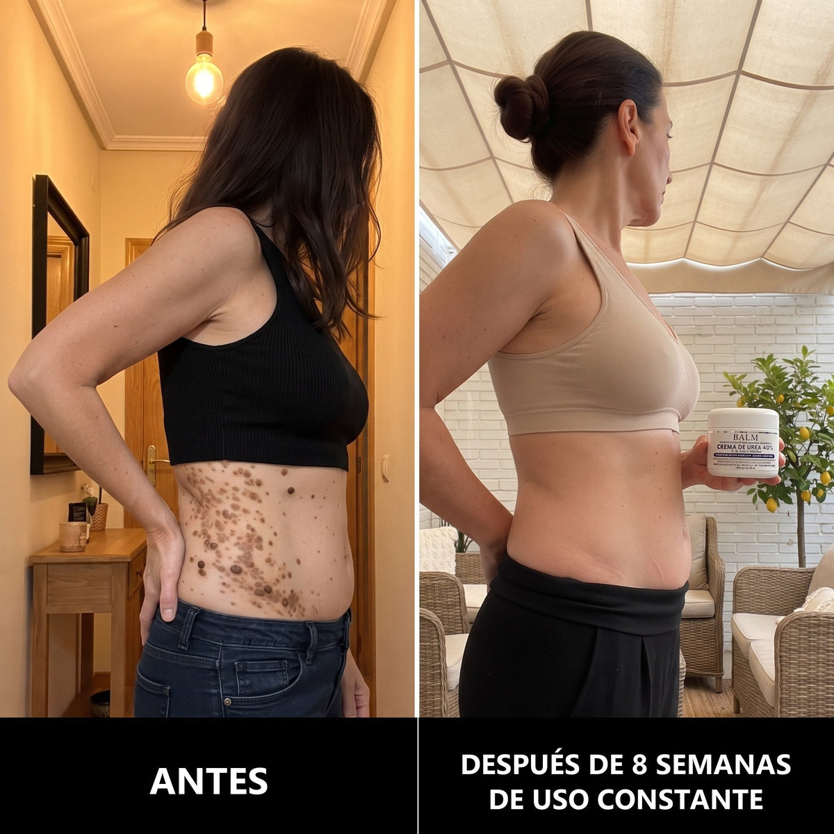 𝗖𝘂𝗿𝗲𝗩𝗶𝘃𝗼® — Crema de Urea al 40 %